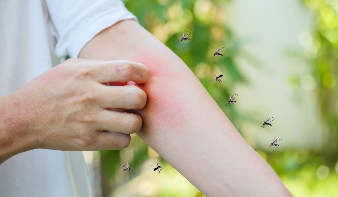 Why Do Mosquito Bites Itch?